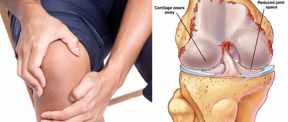 Viêm bao hoạt dịch khớp gối